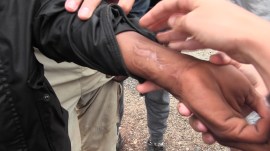 Herida provocada por las cuchillas de la valla